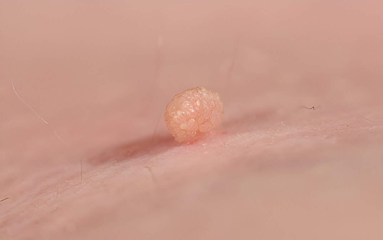 9. Skin Tags